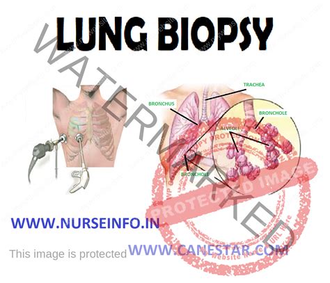 LUNG BIOPSY - Nurse Info