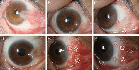 a: Thick and fleshy primary pterygium (S 4 V 3 C 4 K 3 ) is observed ...