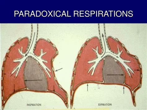 PPT - CHEST TRAUMA PowerPoint Presentation, free download - ID:1438644