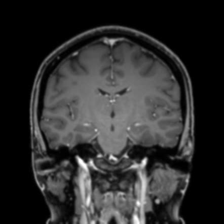 Normal MRI internal auditory canal | Image | Radiopaedia.org