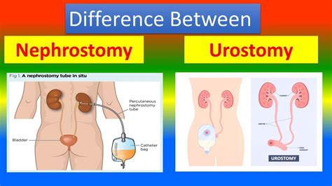 Difference between Nephrostomy and Urostomy - YouTube