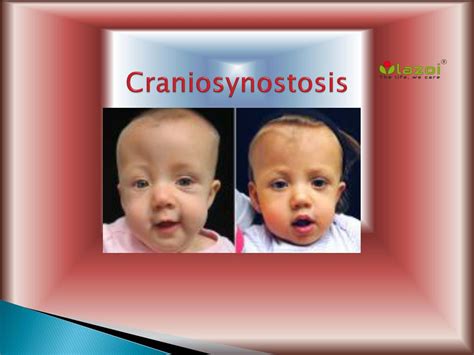 PPT - Craniosynostosis: Types, Causes, Symptoms, Diagnosis and Treatment PowerPoint Presentation ...