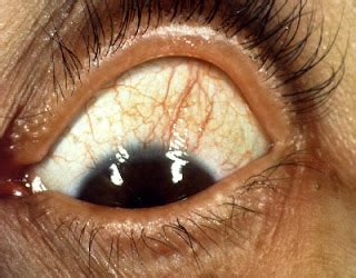 Causes, Signs, Symptoms and Tips to Overcome Dry Eyes (Keratoconjunctivitis Sicca) - Nanda Care Plan