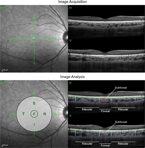 Daily morning light therapy is associated with an increase in choroidal ...