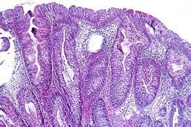 Understanding Sessile Serrated Adenoma: Causes, Symptoms, and Treatment - CuriousQuill