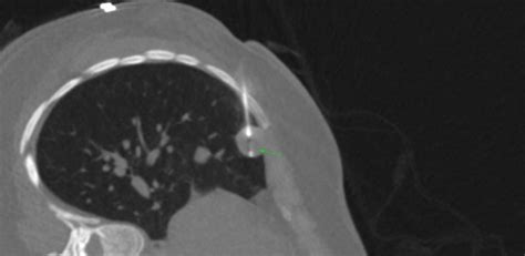 Lung Nodules - 10-20 mm - CT Guided Biopsy