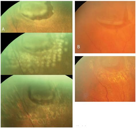 Operculated Retinal Hole In Retinal Detachment Retina