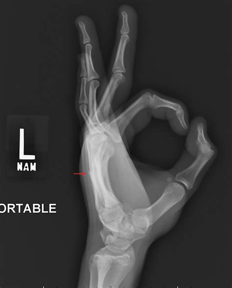 Punchin’ out: Fifth metacarpal (boxer’s) fracture | Radiology Key