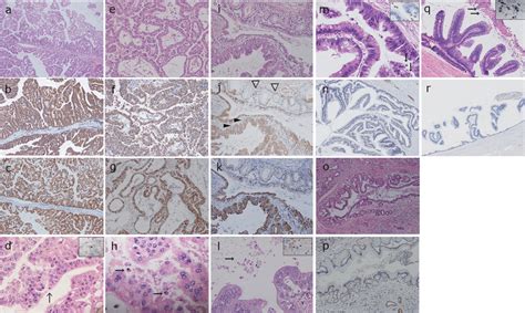 Representative histology and immunohistochemistry of IOPN and ...