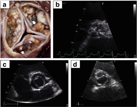 Aortic Valve