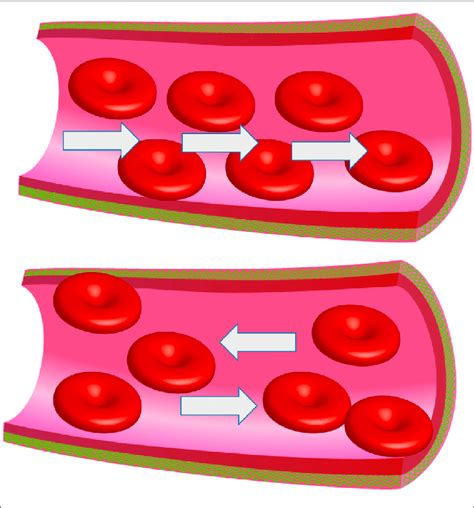 | Abnormal venous valve function. Damaged venous valves result in local ...