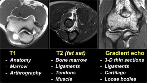 Ulnar Collateral Ligament Mri