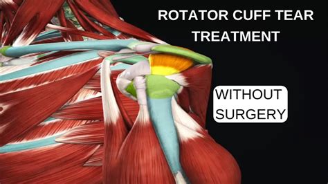 How To Determine Rotator Cuff Tear