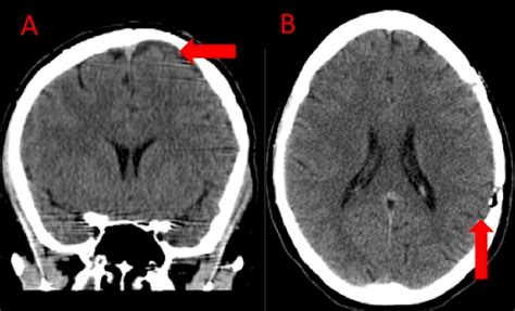 Is Arachnoid Cyst life Threatening? 10 Effective Tips