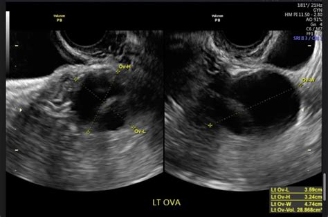 Septated ovarian cyst : r/hysterectomy