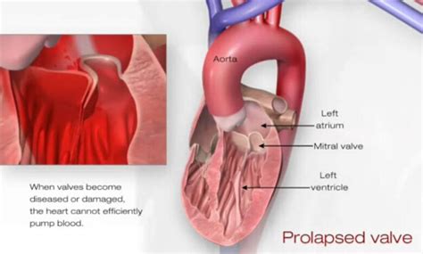 What is mitral valve disease?