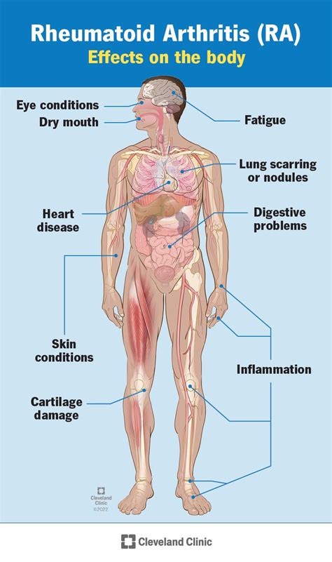 RHEUMATOID ARTHRITIS PANEL – Thyrocare Aarogyam centre