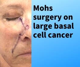 Mohs surgery on large basal cell carcinoma with repair and healing - Ada West Dermatology