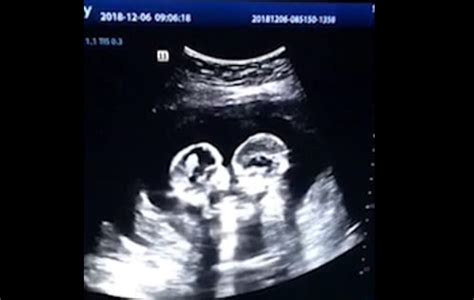 WATCH: Identical Twin Babies Shown on Ultrasound "Fighting" in the Womb - LifeNews.com