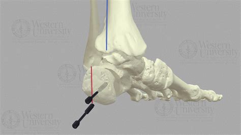 Lateral Calcaneal Slide Osteotomy - 3D model by WesternU3D [3604159 ...