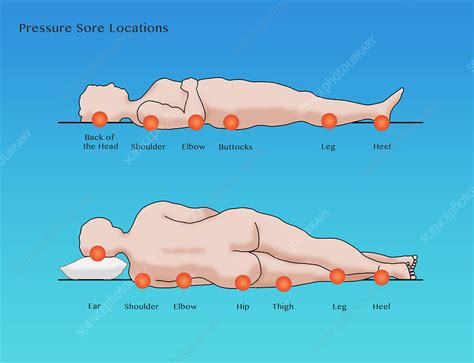 Pressure Sore Locations, Diagram - Stock Image - C030/6114 - Science Photo Library