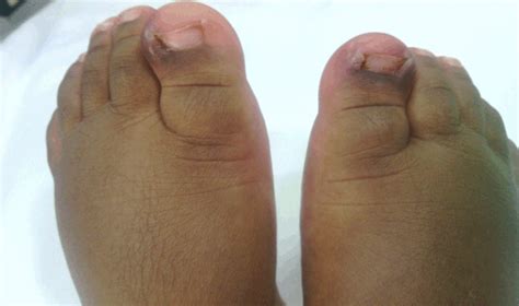 FULL TEXT - Infantile bilateral ingrown toe nails: A case report from sub-saharan Africa ...