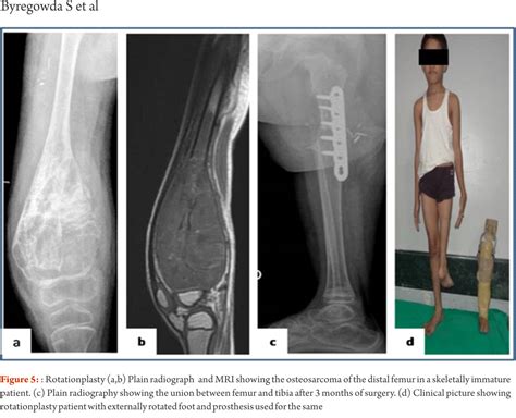 Biological Methods of Reconstruction After Excision of Extremity Osteosarcoma – Journal of Bone ...