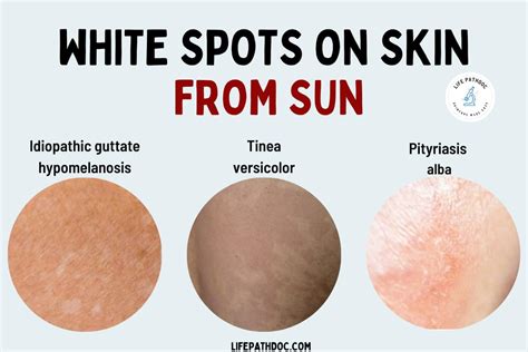 White Spots on Skin from Sun: Causes, Pictures & Treatment