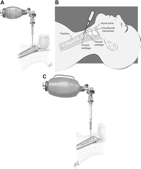 Needle cricothyrotomy. | Semantic Scholar