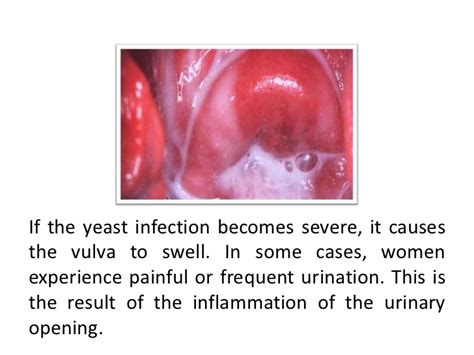 pictures of vaginal yeast infection - pictures, photos