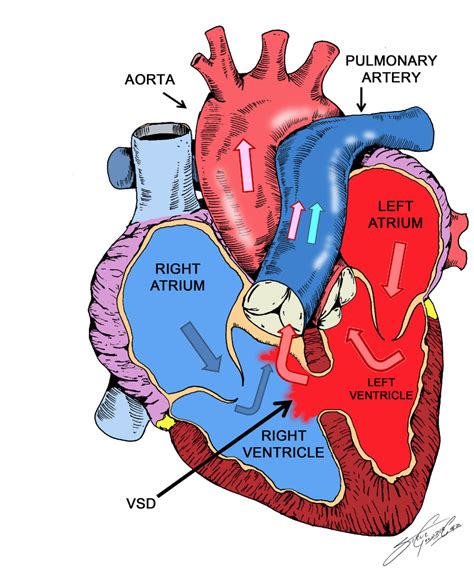 Left To Right Shunt Lesions: Ventricular Septal Defect (VSD)