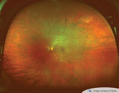 Optomap Retinal Exam