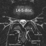 MRI Lumbar Spine Anatomy - Rocky Mountain Brain and Spine Institute