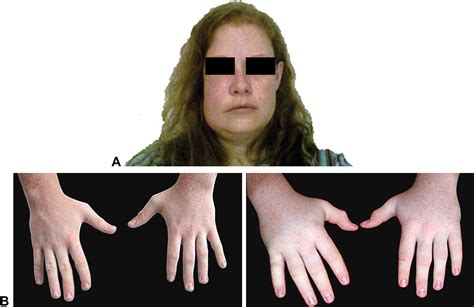 Hereditary Angioedema