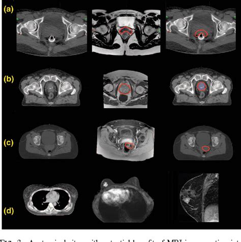 MRI simulation for radiotherapy treatment planning. | Semantic Scholar