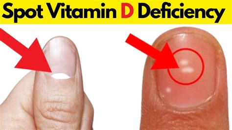 5 Signs and Symptoms of Vitamin D Deficiency - YouTube