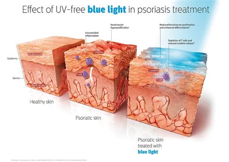 Effective, Empowering and Life-Changing: New blue light therapy with Philips BlueControl – a big ...