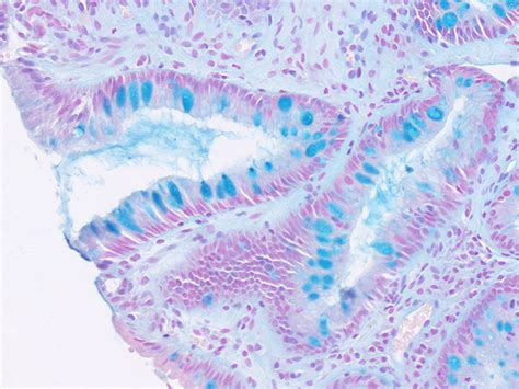 Alcian Blue pH 2.5, Barrett's Esophagus Histology Slides