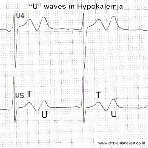 When sinus bradycardia accompanies hypokalemia “U” waves appear in a dramatic fashion ! | Dr.S ...