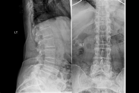 Compression Fracture Lumbar