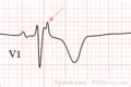 File:Epsilon wave.png - ECGpedia