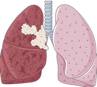 Pictures of Lungs After Quit Smoking & How We Can Help