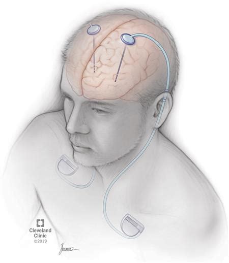 Deep Brain Stimulation (DBS): What It Is, Purpose & Procedure