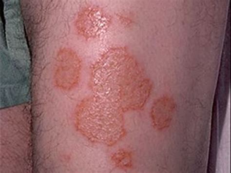 Atopic Dermatitis, Eczema, and Noninfectious Immunodeficiency Disorders ...