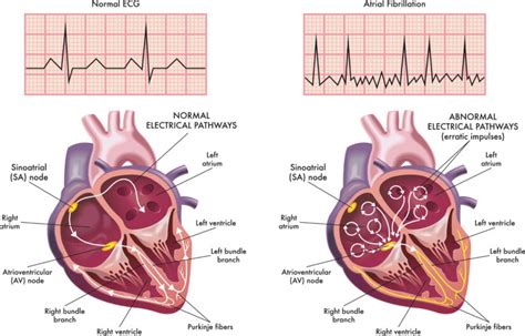 Atrial Fibrillation - Cause, Symptoms, Complications & Treatment in Hyderabad