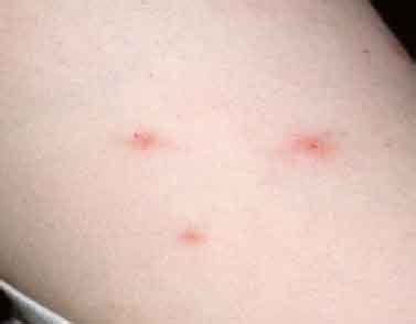 Bed Bug Bite Marks: Body Pictures, Treatment | Free Brochure