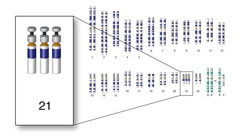 Down Syndrome (Trisomy 21)