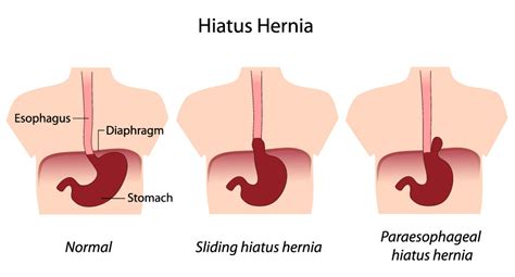 Hiatus Hernia - Jackson Siegelbaum Gastroenterology