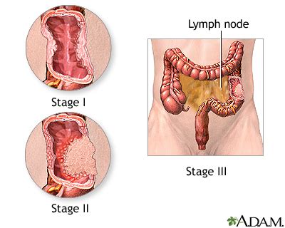 Colon cancer - series—Incision: MedlinePlus Medical Encyclopedia