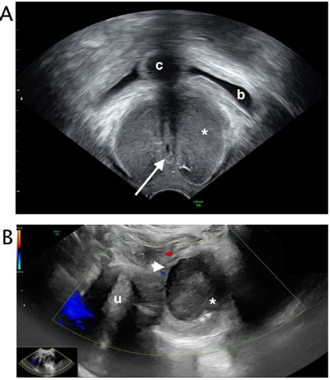 Figure 3 from Skene's glands abscess an overlooked diagnosis in acute lower urinary symptoms ...